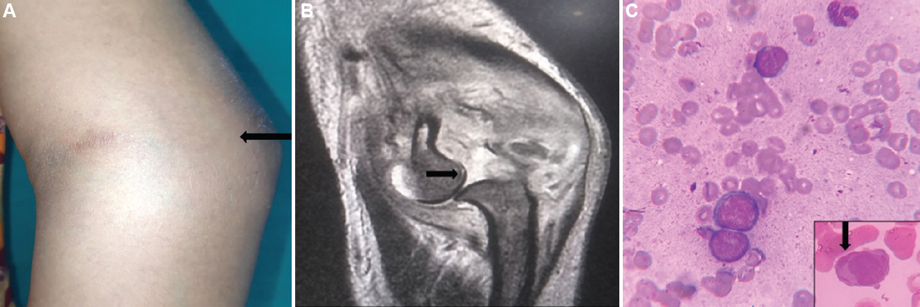(A) Photograph showing the left elbow swelling (arrow). (B) T2-weighted magnetic resonance image (coronal section) of the left elbow joint showing a large lesion impinging onto the articular surface and destruction of the joint along with the posterior subluxation of radius (arrow). (C) Fine-needle aspiration from the swelling showing blasts (LG, ×40); inset showing a blast with the Auer rods (arrow) (LG, ×100). LG, Leishman Giemsa stain.